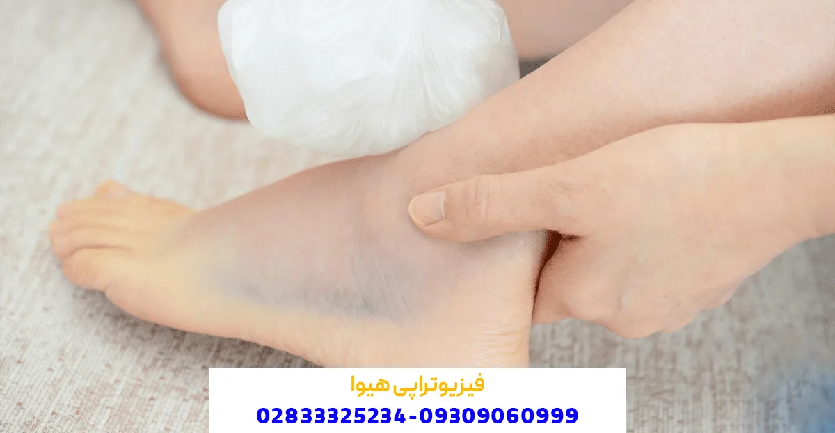 درمان پیچ خوردگی مچ پا با فیزیوتراپی