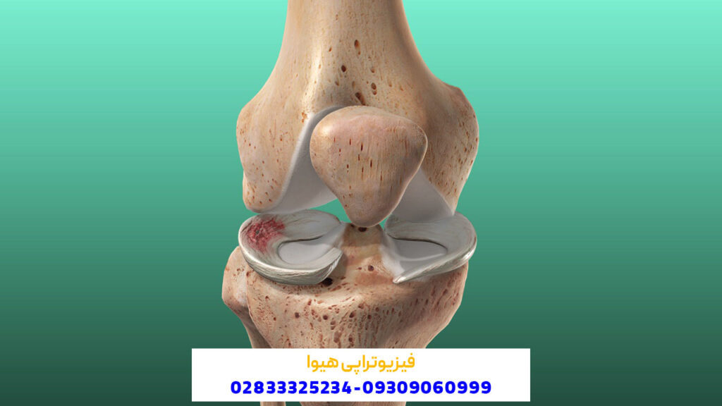 آسیب‌ های مینیسک زانو به چه معناست؟