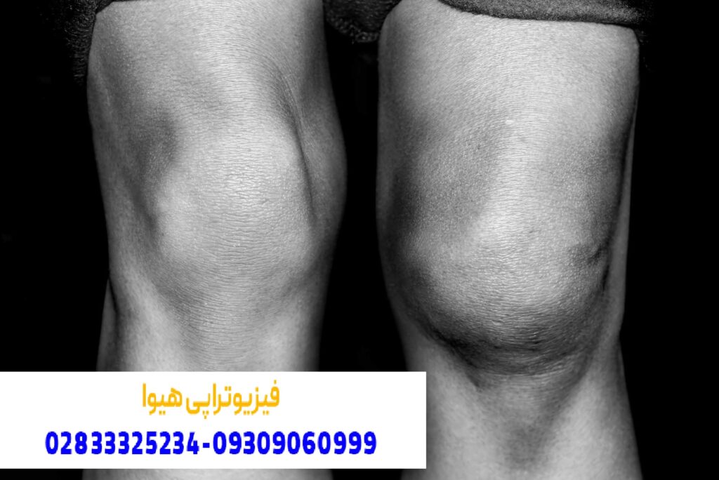 روش های درمان ورم زانو چیست