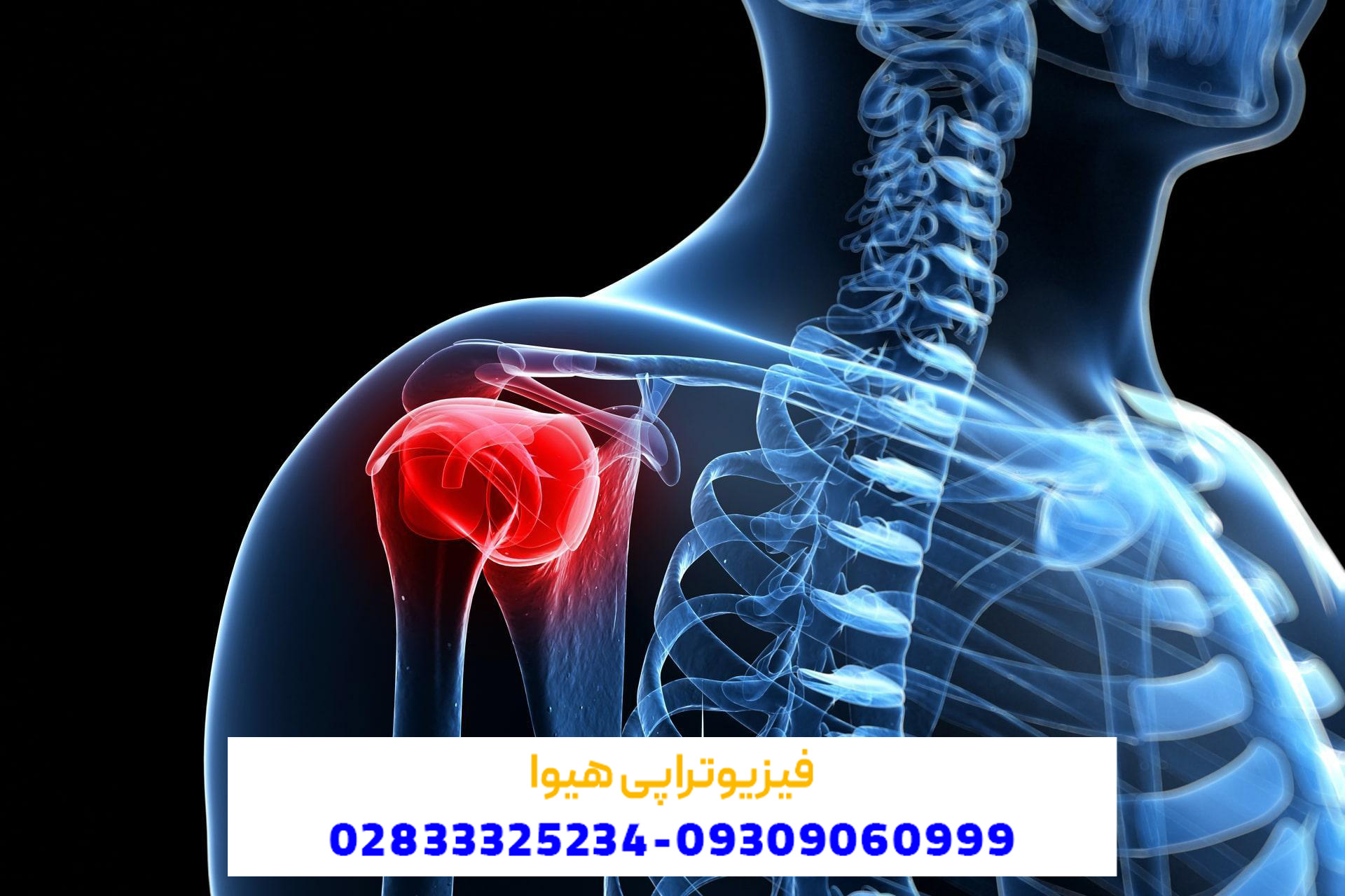 منظور از شانه یخ زده چیست و چه علائمی دارد