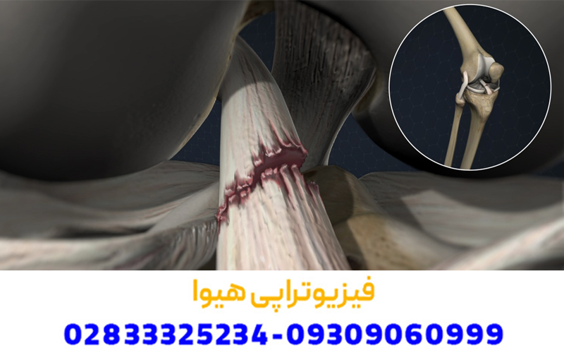  تشخیص و معاینه آسیب و پارگی رباط صلیبی
