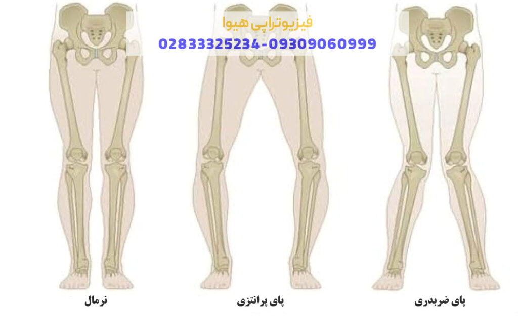 درمان انحراف زانو با فیزیوتراپی