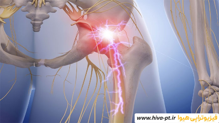 آیا فیزیوتراپی می تواند به کاهش درد سیاتیک کمک کند؟