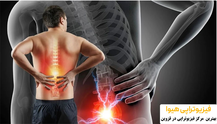 آیا فیزیوتراپی می تواند به کاهش درد سیاتیک کمک کند؟