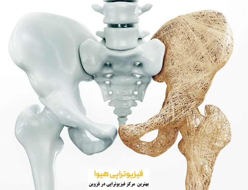 فیزیوتراپی برای پوکی استخوان
