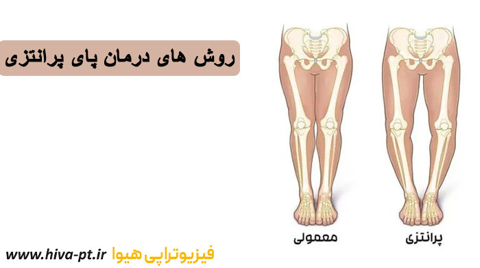 فیزیوتراپی پای پرانتزی