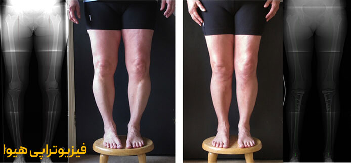 فیزیوتراپی پای پرانتزی