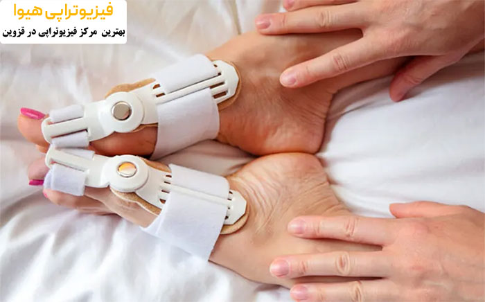 درمان هالوکس والگوس با فیزیوتراپی