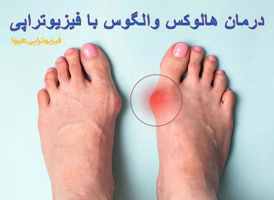 درمان هالوکس والگوس با فیزیوتراپی