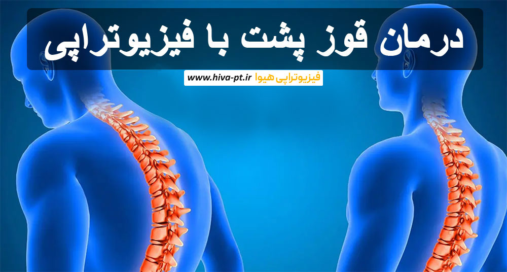 درمان قوز پشت با فیزیوتراپی