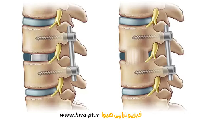 فیزیوتراپی بعد از عمل فیوژن کمر