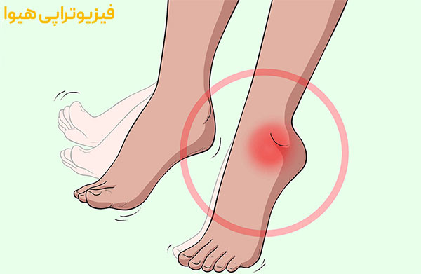 دراپ فوت (drop foot) چیست؟