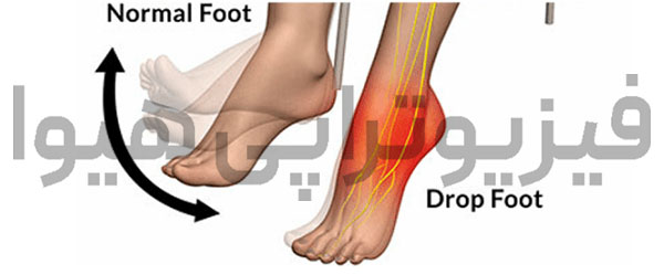 دراپ فوت (drop foot) چیست؟
