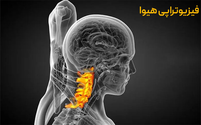 درمان تنگی کانال نخاعی گردن با فیزیوتراپی