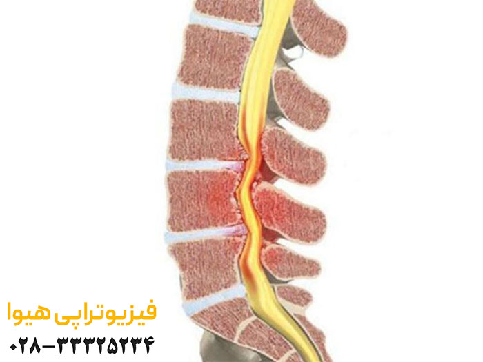 درمان تنگی کانال نخاعی گردن با فیزیوتراپی