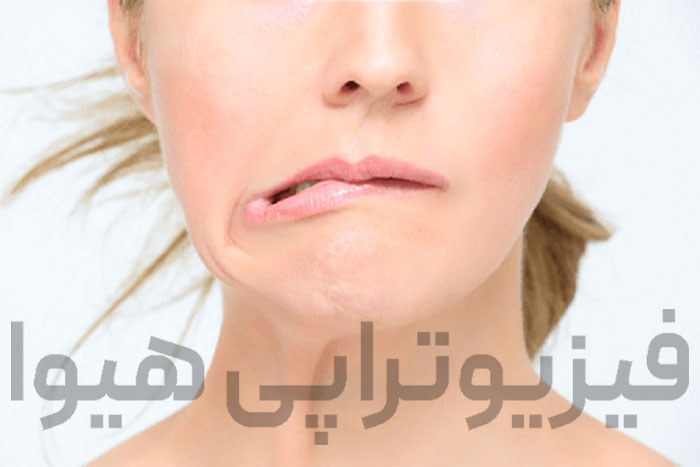 روش های موثر درمان فلج بلز