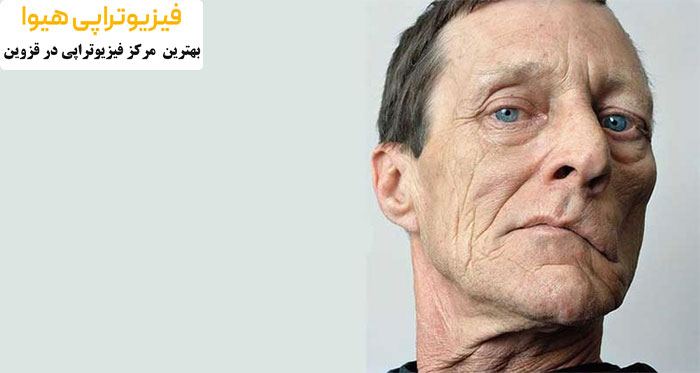 فلج بلز یا فلج عصب هفتم صورت