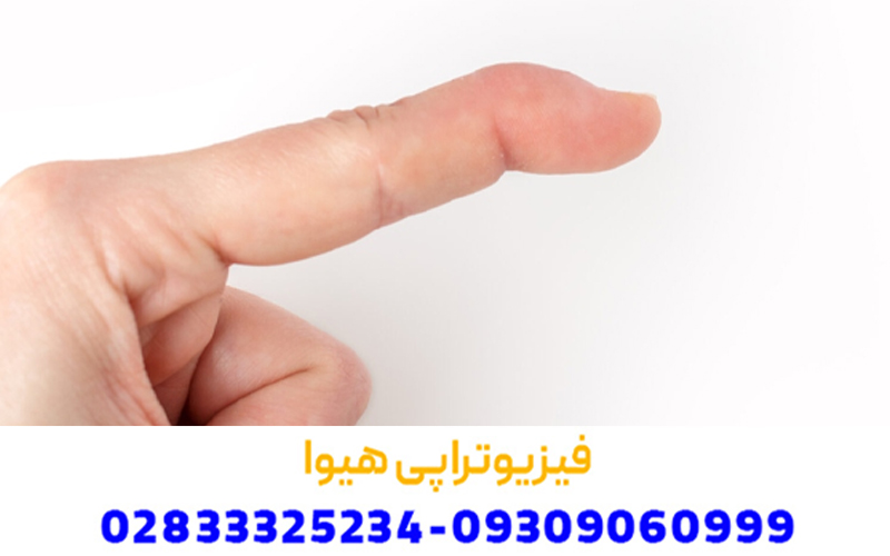 دلایل رایج انگشت چکشی در دست