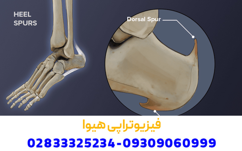 علت خار پاشنه چیست و چه علائمی دارد