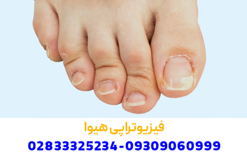 علائم رایج انگشت چکشی در پا