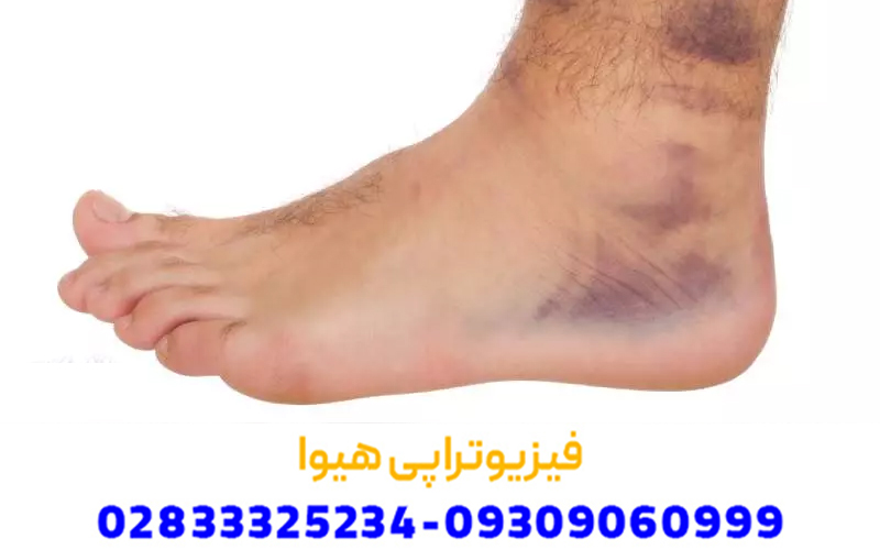 اطلاعات عمومی پیچ خوردگی مچ پا