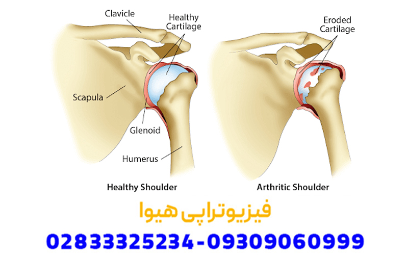 علائم آرتروز مفصل شانه چیست؟
