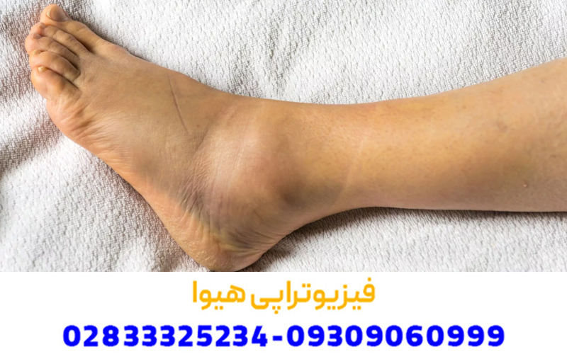اطلاعات عمومی پیچ خوردگی مچ پا