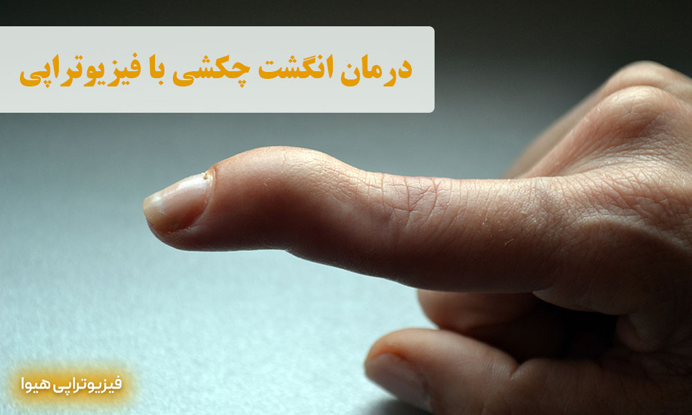 درمان انگشت چکشی با فیزیوتراپی