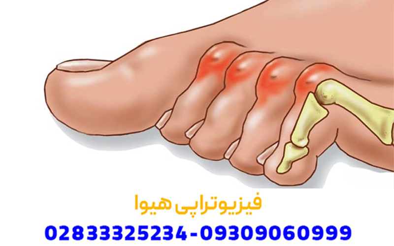درمان انگشت چکشی با فیزیوتراپی