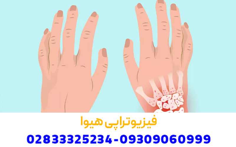 علائم و نحوه تشخیص آرتروز مچ دست