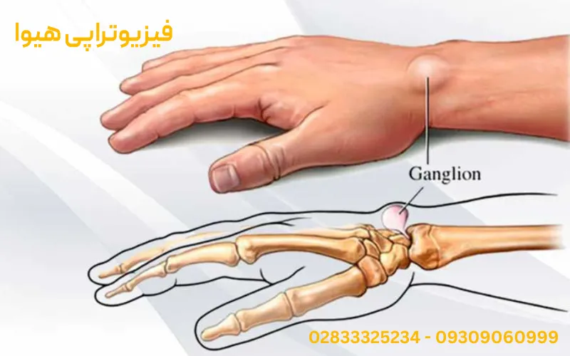  علائم ناشی از وجود کیست گانگلیون