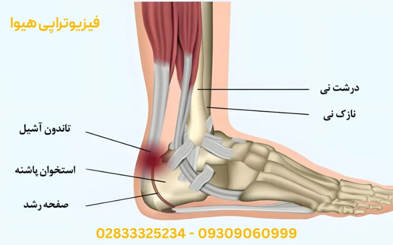انواع التهاب تاندون آشیل و ویژگی هر کدام