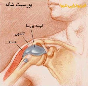 درمان بورسیت شانه