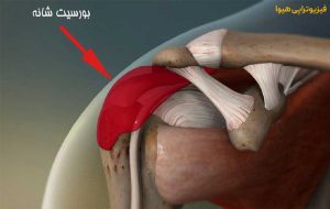 عوامل بروز بورسیت شانه 