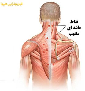 درمان تریگرپوینت یا نقاط ماشه ای