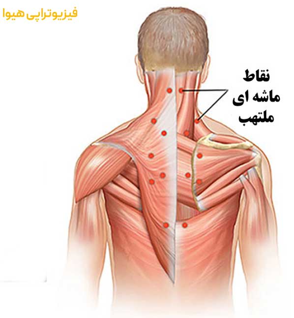 درمان تریگرپوینت یا نقاط ماشه ای