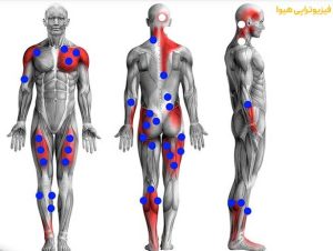 روش های درمان تریگرپوینت