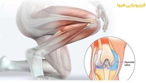 سندرم پلیکا چیست؟