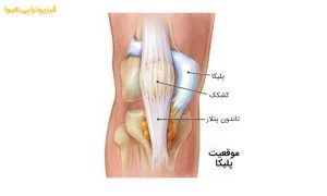 روش های درمان سندرم پلیکا