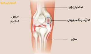 اهمیت درمان سندرم پلیکا با فیزیوتراپی