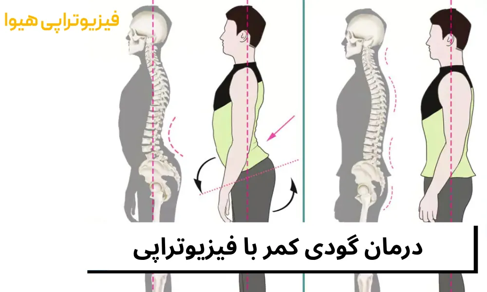 درمان گودی کمر با فیزیوتراپی