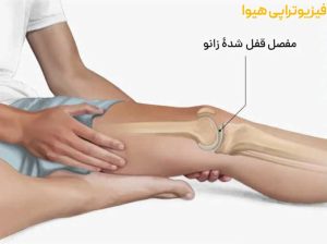 انواع قفل شدن زانو