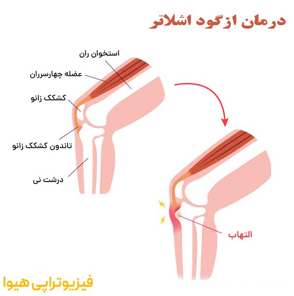 چند روش درمان ازگود اشلاتر + علل و علائم