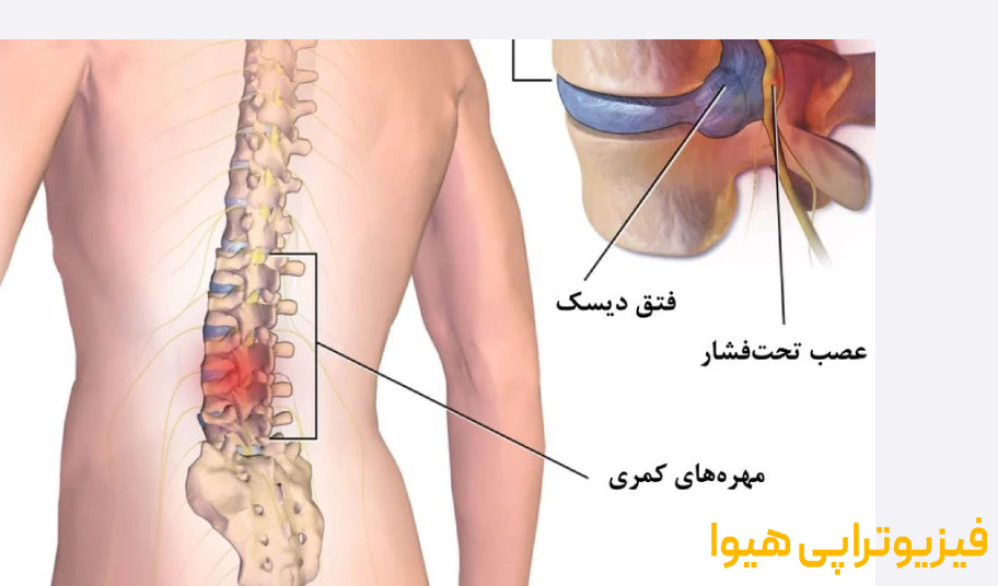 راهنمای کامل مشکلات ستون فقرات و کمر