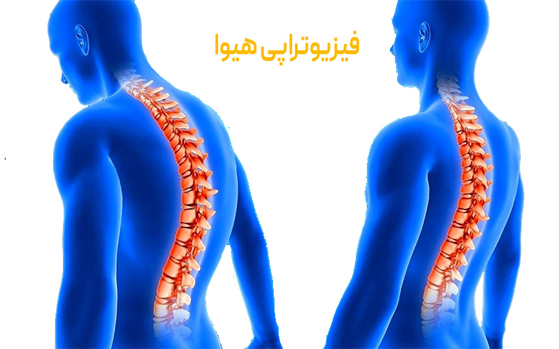 نقش فیزیوتراپی در درمان بیماری های ستون فقرات
