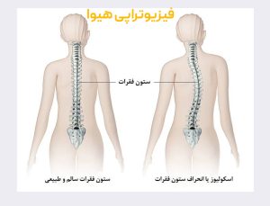 بیماری های ستون فقرات و کمر