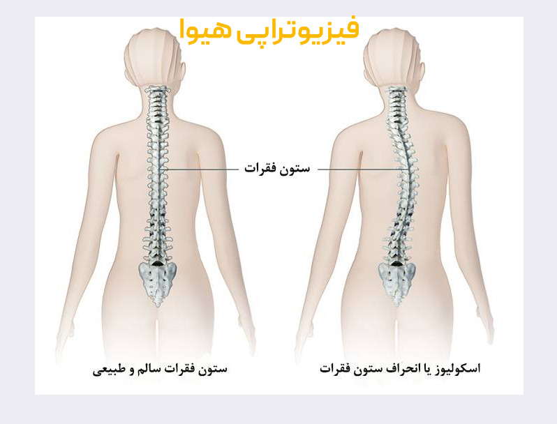 بیماری های ستون فقرات و کمر