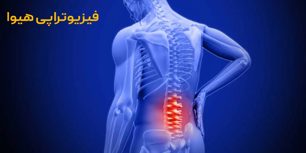 نقش فیزیوتراپی در بهبود دیسک پاراسنترال
