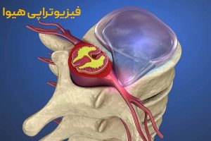 دیسک پاراسنترال