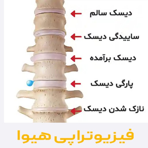 دیسک پاراسنترال چیست و چرا ایجاد می شود؟